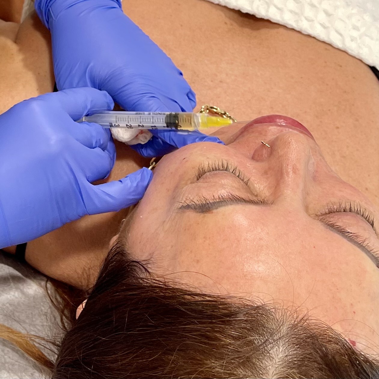 PRP Face Injections