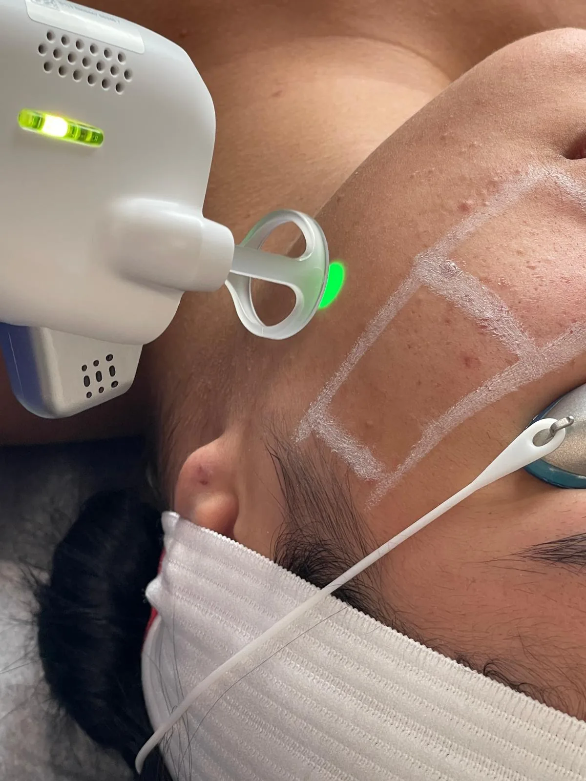 Laser Facial Rejuvenation
