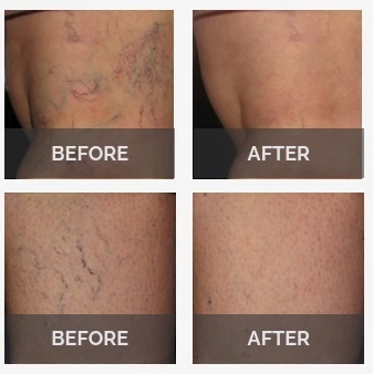 Before and After Vein Treatment